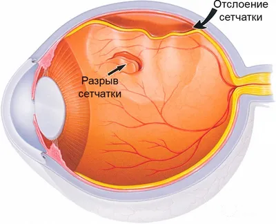 Лечение сетчатки глаза | Центр зрения – сеть офтальмологических клиник |  Дзен