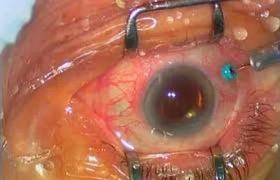 Дистрофия - это наиболее частая причина поражения сетчатки глаза. В  результате патологического процесса возникает омертвление клеток сетчатки,  что... | By sozvezdie52 | Facebook