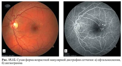 Лечение возрастной макулярной дистрофия сетчатки (ВМД) в сети клиник  Глазной Доктор