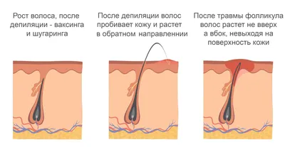 Шугаринг или воск — что выбрать? | Что лучше шугаринг или воск? | SugarMe