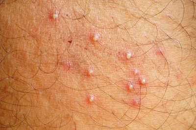 Т-клеточные лимфомы кожи: современные аспекты лечения
