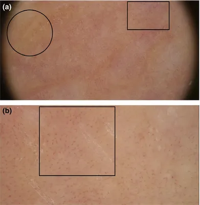 Базалиома (базальноклеточный рак кожи): симптомы, лечение, фото