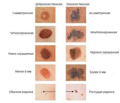 Удаление новообразования с пластикой дефекта местными тканями под  эндотрахеальным наркозом - Официальный сайт ФНКЦ детей и подростков ФМБА  России