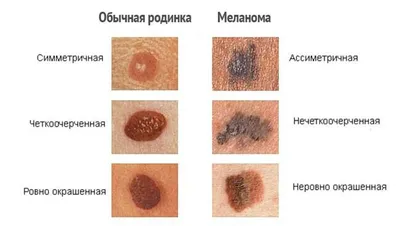 Меланома кожи: фото, стадии, симптомы. Лечение меланомы, диагностика