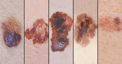 Меланома: фото кожи, симптомы, лечение, начальная стадия