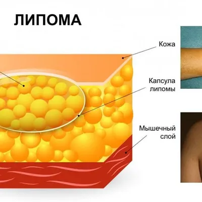 Доброкачественные опухоли у детей, их профилактика – тема научной статьи по  клинической медицине читайте бесплатно текст научно-исследовательской  работы в электронной библиотеке КиберЛенинка