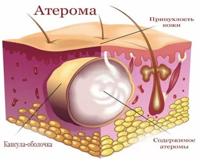 Опухоли кожи и мягких тканей - Клиника медицинского университета