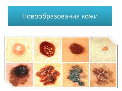 Диагностика и лечение новообразований кожи и подкожной клетчатки в  Краснодаре в клинике УРО-ПРО