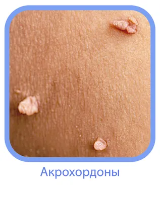 Плоскоклеточный рак кожи: клинические рекомендации