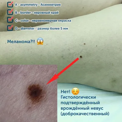 Удаление вирусных образований на коже в Москве, цена в Клинике подологии  Полёт