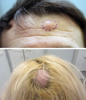 Новообразования на коже волосистой части головы