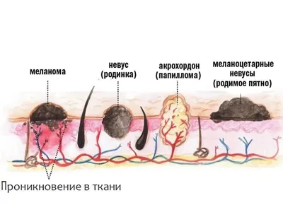 Онко Вики — Формы меланомы