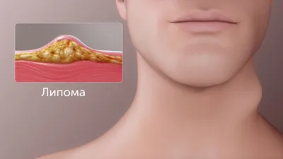 Что такое фиброма на коже и как ее лечить | МЦ Лазерсвiт