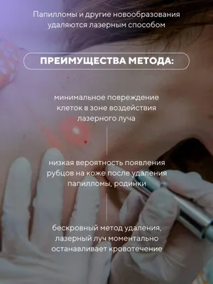 Как определить – бородавка или нет? ✓ Авторские статьи Клиники подологии  Полёт в Москве