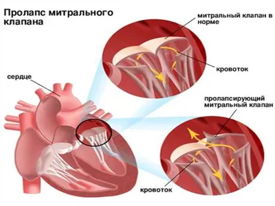 Ответы Mail.ru: что такое доп хорда в сердце и чем это опасно