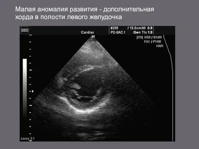 Дополнительная хорда в сердце у ребенка - что это такое и чем опасна?