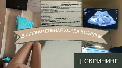 dr.kardiologist - Вам когда нибудь выполняли ЭХОКГ? Очень часто в  заключении исследования можно увидеть фразу «дополнительная хорда». Стоит  ли беспокоиться по этому поводу❓ ✓В сердце человека есть несколько хорд,  которые во время