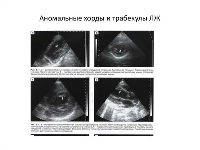 Пролапс митрального клапана (ПМК) - online presentation