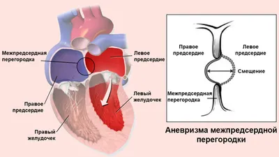 Малые аномалии сердца - презентация онлайн