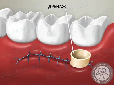 Дренаж В Десне Зуба Хирургия После Операции ЛюмиДент