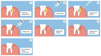 Дренаж В Десне Зуба Хирургия После Операции ЛюмиДент