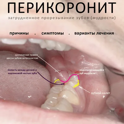 Воспаление зубов (десен) - лечение в стоматологии \"Дента\"