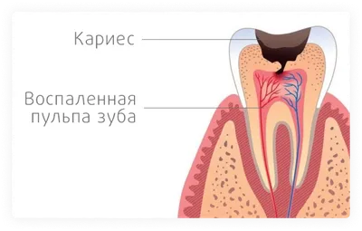 Гнойник на десне (абсцесс десны, зуба) – что делать, виды, методы лечения