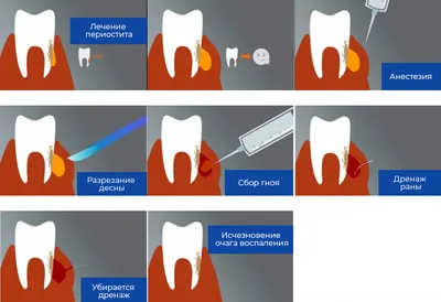 Флюс на десне. Лечение и симптомы. Цена, отзывы | | НоваДент