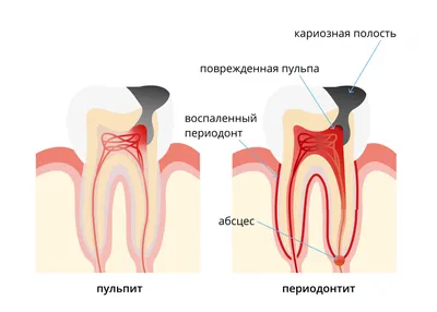 Дренаж в десне - зачем ставят, установка, снятие (удаление)