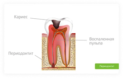 Периодонтит - что это, осложнения, лечение -