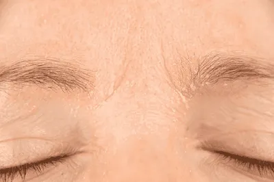 Сухая кожа: особенности ухода — Сеть косметологических клиник Эпилайк