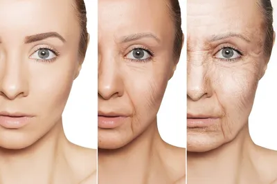 концепция ухода за кожей и здоровья. морщины мелазма темные пятна веснушки  сухая кожа на лице женщины среднего возраста. Стоковое Изображение -  изображение насчитывающей персона, взорвать: 216328333