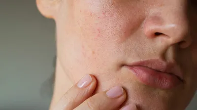 Шелушится кожа на лице: причины и лечение шелушений, появление сухости и  симптомы заболеваний