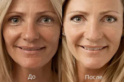 Причины сухой кожи лица и как от нее избавиться | Клиника “Elevans”