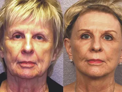 Дряблая кожа лица (потеря тонуса) | Решение проблем в клинике BeautyWay  Clinic