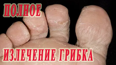 ☆ Complete cure the fungus between the toes. The drugs and folk remedies. -  YouTube