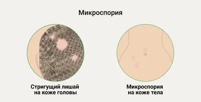 Дрожжевые инфекции: заболевания, лечение и препараты