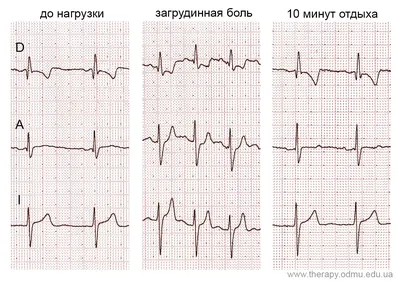 ЭКГ-признаки ишемии миокарда