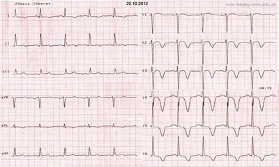 ЭКГ-признаки ишемии миокарда