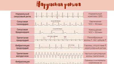 Расшифровка результатов ЭКГ в Минске — медцентр Золотое Сечение