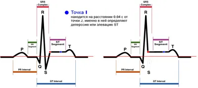 Инфаркт миокарда: передне-перегородочный и передне-распространенный