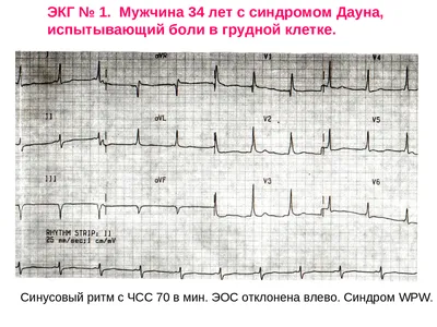 Элевация сегмента ST и инфаркт миокарда - E-Cardio