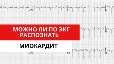 ЭКГ: что это такое, кому назначают и как расшифровать