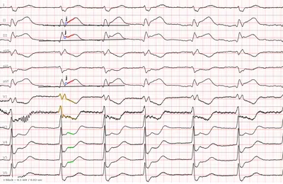 ЭКГ при МИОКАРДИТЕ. Как отличить от инфаркта. - YouTube