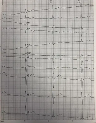 Элевация сегмента ST и инфаркт миокарда - E-Cardio