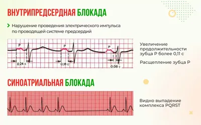 МЕТОДИЧЕСКИЕ РЕКОМЕНДАЦИИ Тема: Электрокардиограмма при инфаркте ми