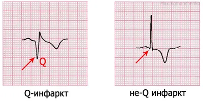 Острый коронарный синдром. Инфаркт миокарда. STEMI и Non-STEMI. OMI и NOMI.