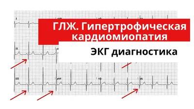 Элевация сегмента ST и инфаркт миокарда - E-Cardio