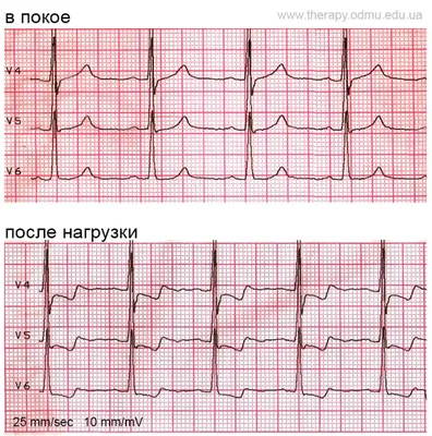 ЭКГ-признаки ишемии миокарда