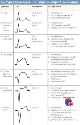 Признаки инфаркта миокарда с подъемом сегмента ST на ЭКГ